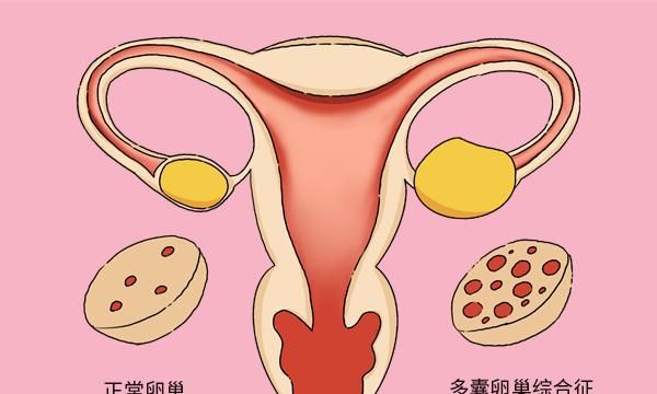 多囊卵巢有多少种怀孕方式？体外受精是唯一的选择吗？